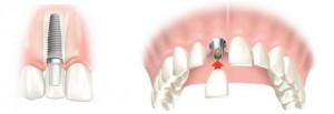 drawing of a dental implant in a jaw