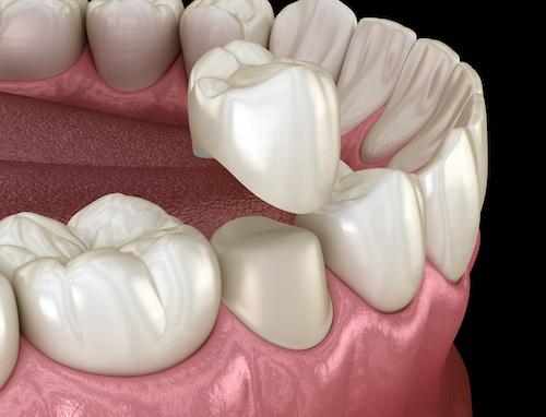 Digital image of dental crown covering tooth in Tampa, FL