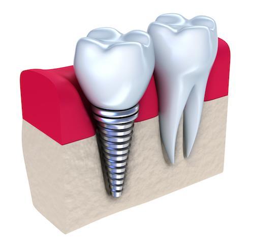 graphic of a dental implant in the gums