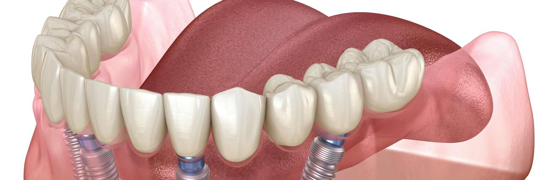 A close-up photograph of dental implants