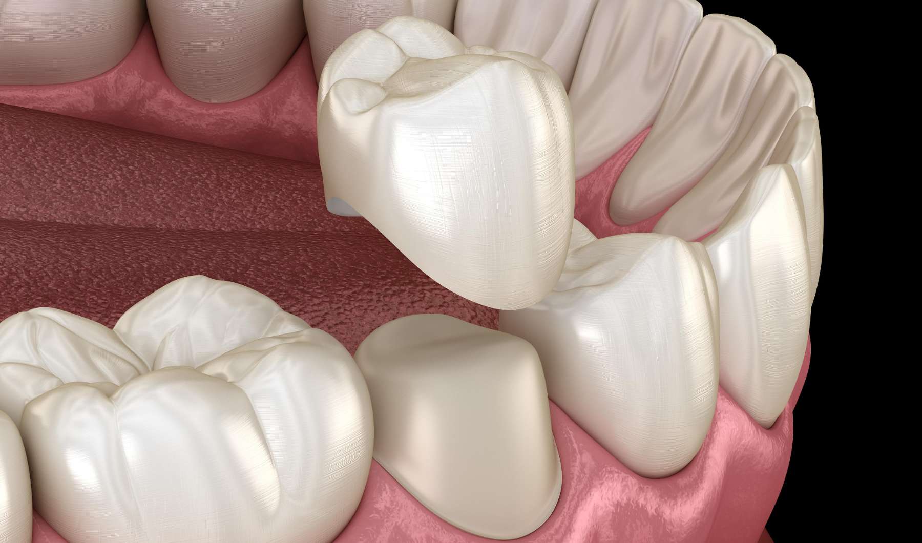 Graphic of dental crown covering tooth at dentist in Tampa, FL