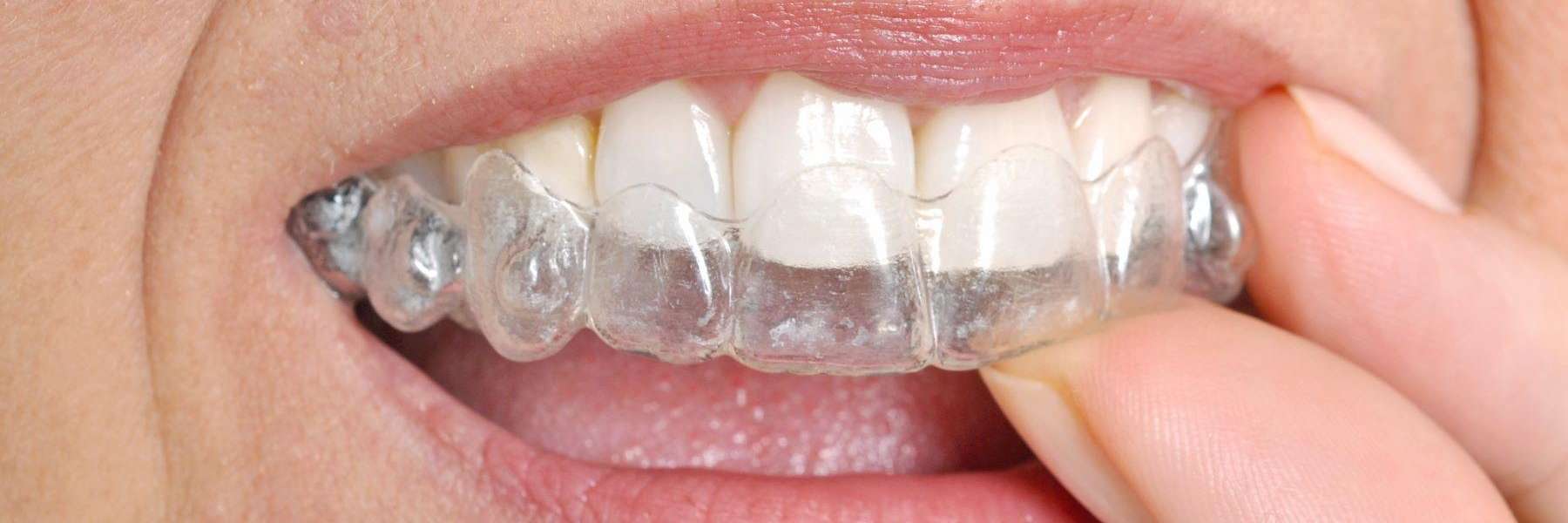 best clear aligner sets | north tampa