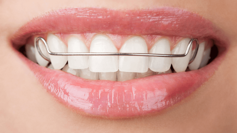 Close-up of teeth with retainer in North Tampa