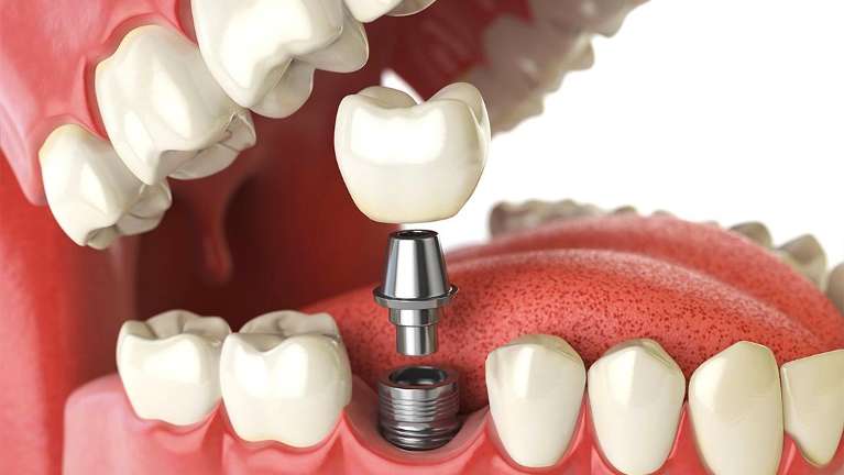 Diagram of dental implant in Tampa, FL