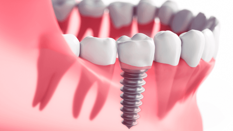 Illustration of dental implant placement in North Tampa