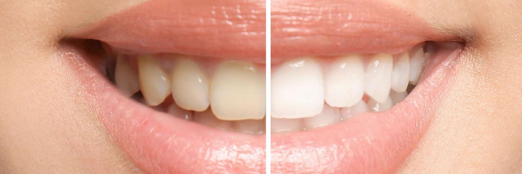 teeth whitening in tampa fl