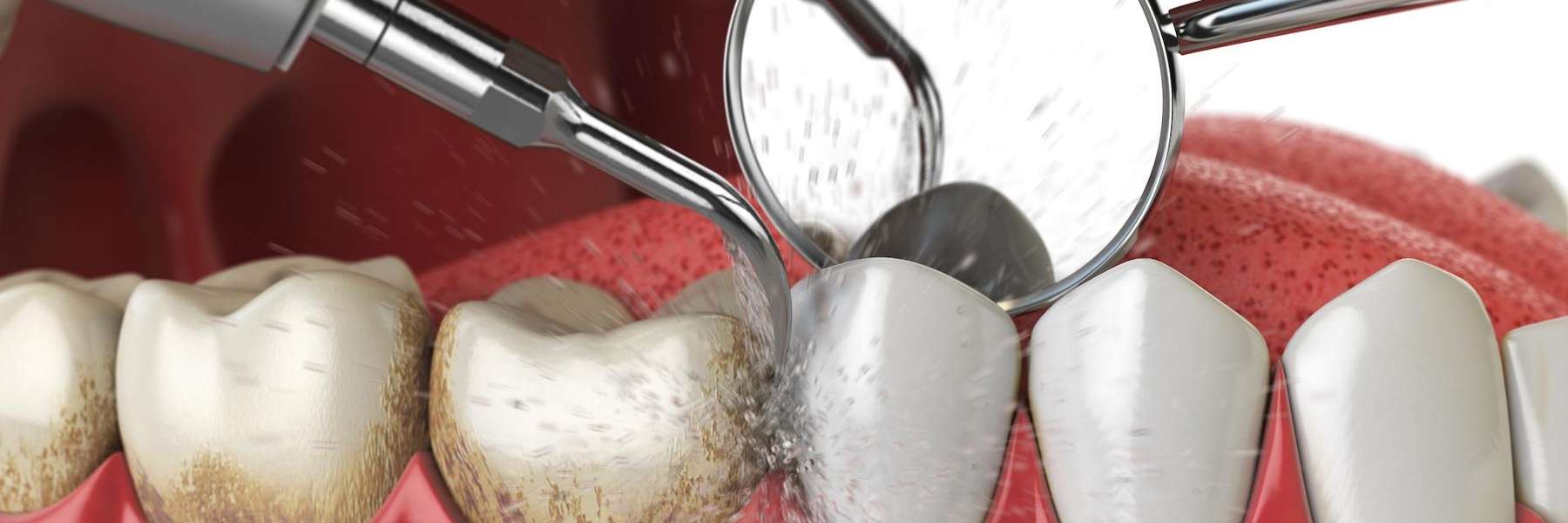 A close-up photograph capturing a tooth cleaning procedure in progress