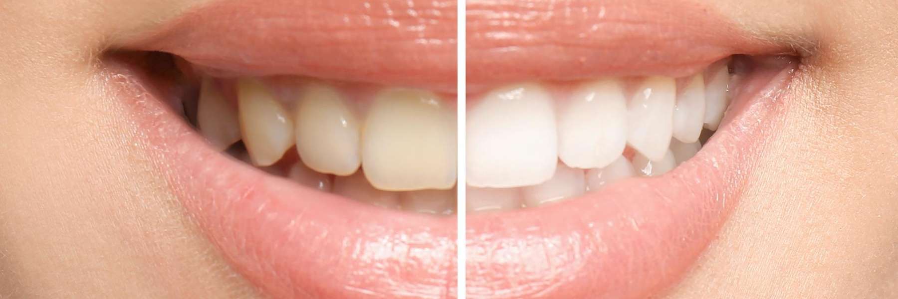 Discolored teeth versus White teeth in Tampa