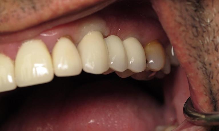 Dental-Implants-After-Image