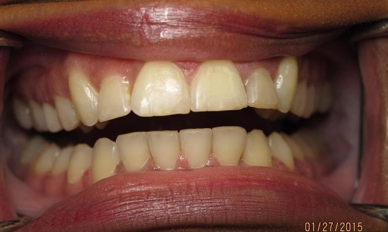 Six-Month-Smiles-Orthodontics-After-Image