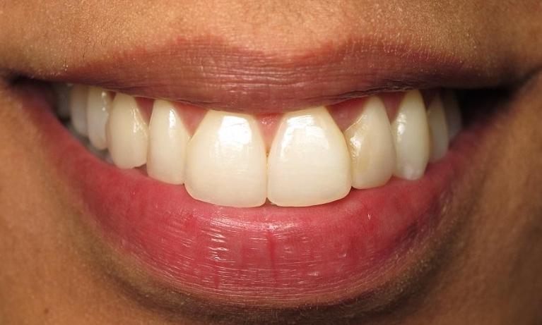 Orthodontics-After-Image