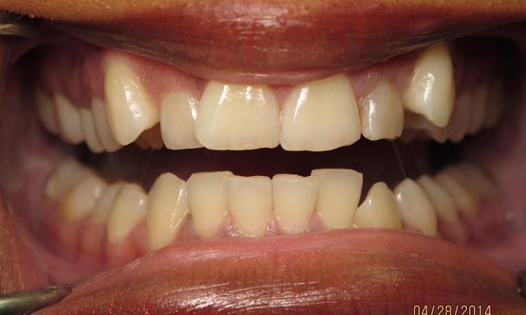 Six-Month-Smiles-Orthodontics-Before-Image