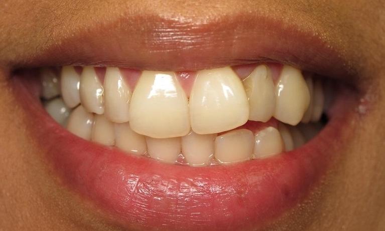 Orthodontics-Before-Image