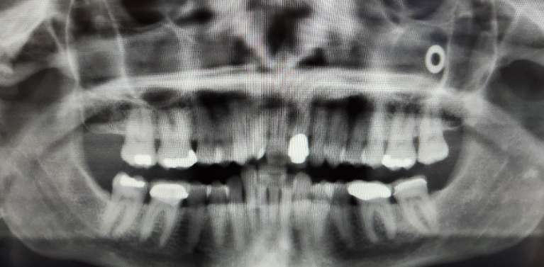 Intraoral Camera Image, North Tampa Dentist